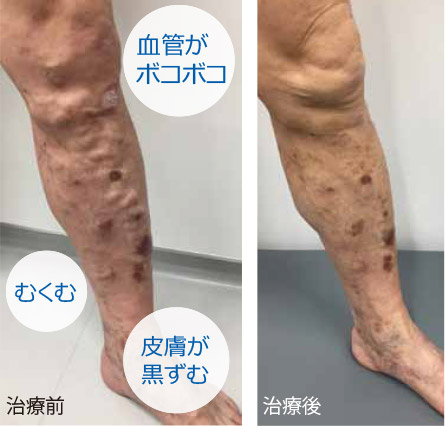 血管がボコボコ　むくむ　皮膚が黒ずむ